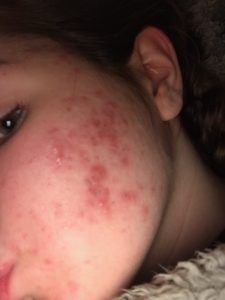 facial acne, cystic acne of teenager