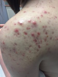 example of cysteic acne, scarring 2018