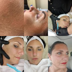 Dermaplaning peach fuzz