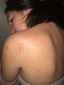 improved shoulder acne after using our treatments 