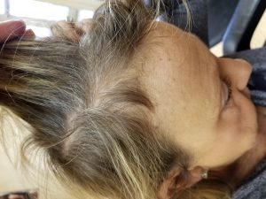 thinning hair that has grown in