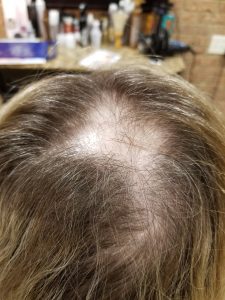 Permanent hair loss from pony tailing as a young child